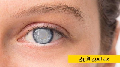 3% من التونسيين مصابون بمرض الكحلي و اطباء الاختصاص يؤكدون على ضرورة التقصي المبكر.