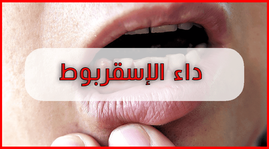 الإسقربوط والأسنان: خبيرة تغذية تكشف التفاصيل